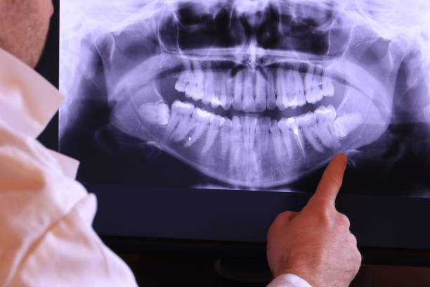 Best Emergency Wisdom Teeth Removal in Genesee, ID
